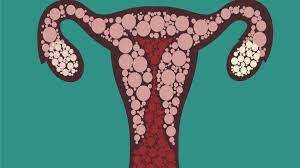 Unmarried Girls Reluctant To Seek Treatment For Endometriosis