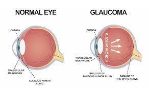 World Glaucoma Day: ‘4.5 million people are blind because of Glaucoma globally’