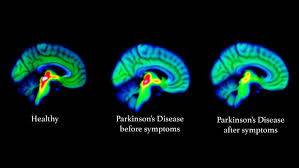 Shocking Lack Of Awareness Surrounding Parkinson's Disease In Pakistan